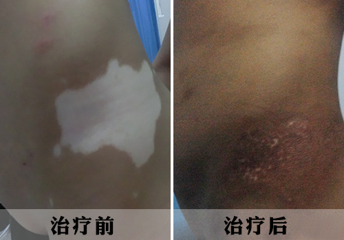 北京国丹白癜风医院