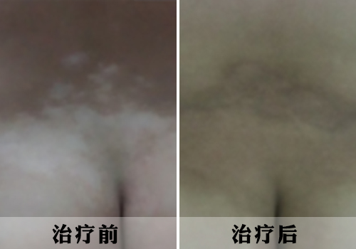 北京国丹白癜风医院