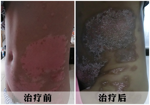北京国丹白癜风医院